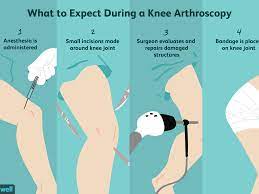 Risks And Complications Of Knee Arthroscopy Surgery