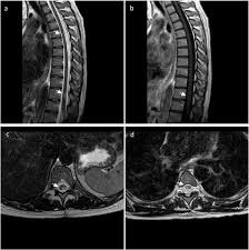 Es gibt tatsächlich mehr zwischen himmel und erde, als die schulweisheit sich träumen lässt, aber dazu braucht es keine neue theorie, die letztlich doch nur. Neuropathic Pruritus As The P Resenting Symptom Of Lupus Transverse Myelitis Journal Of The Neurological Sciences