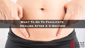 What To Do To Facilitate Healing After A C Section C Section Healing Body