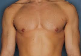 There are different types of breast reduction that will also influence the fees. Male Breast Reduction Gynecomastia Birmingham Al Dr Al Cohn