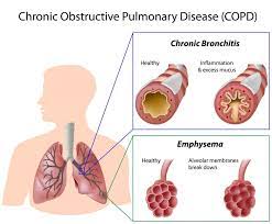 Chronic obstructive airways disease following treated pulmonary tuberculosis. Explainer What Is Chronic Obstructive Pulmonary Disease