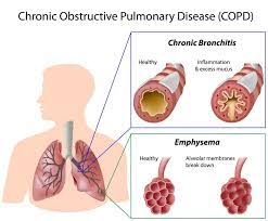 Chronic bronchitis and emphysema are two different lung diseases with similar symptoms. Explainer What Is Chronic Obstructive Pulmonary Disease