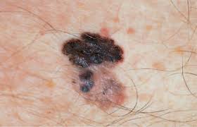 Treatment the standard treatment for skin cancer is surgical removal of the cancer. What Does Skin Cancer Look Like A Visual Guide To Warning Signs Allure