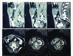 Symptoms associated with ct scan of the uterus. Abdominal Ct Scan Shows Mass Of Endometriosis Download Scientific Diagram