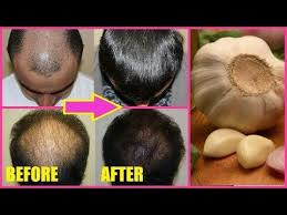 Hair Restore Biotin Hair Growth Serum How To Use In Hindi Hair Regrowth Before And After Using Garlic Garlic Hair Oil Fast Hair Regrowth Hair Loss Remedy Fast Hair Regrowth Help Hair Loss Hair Loss Natural Remedy