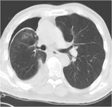 Lung scarring and a permanent decrease in lung function are associated with chronic pleural it can help decide whether the fluid is free flowing within the pleural space or whether it is contained in a specific area (loculated). Trapped Lung Syndrome Pulmonology Advisor