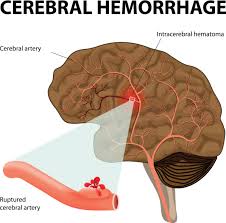 Un aneurisma cerebrale è una protuberanza permanente, simile ad una sacca, di un vaso arterioso del cervello. Aneurisma Cerebrale Cos E E Quanto E Pericoloso Stetoscopio Rivista Medica Online