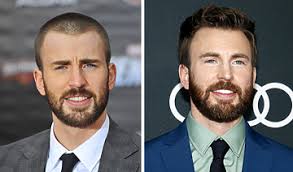 Chris Evans' Hair Transplant