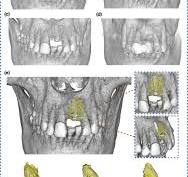Tenting Screw Technique for Horizontal Alveolar Bone ...