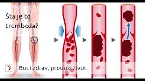 Tromboza venoasa profunda este reprezentata de formarea unui cheag de sange (tromb) in venele profunde ale membrelor inferioare, pelvisului sau membrele superioare. Sta Je To Tromboza Youtube