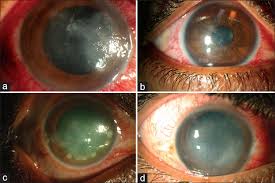 Hsv keratitis is usually diagnosed based on a patient's health history and findings from an eye exam. Non Contact Lens Related Acanthamoeba Keratitis Garg P Kalra P Joseph J Indian J Ophthalmol