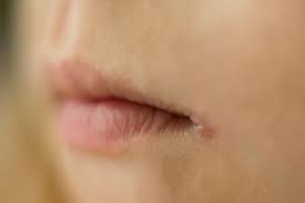 Maybe you would like to learn more about one of these? Angular Cheilitis Luka Di Sudut Bibir Penyebab Dan Pengobatan