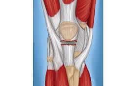 When the tendon is healed, it will still have a thickened, bowed appearance that feels firm and woody. Patellar Tendon Tear Orthoinfo Aaos