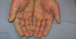 Image result for dermatitis contacta allergica