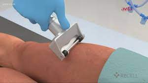 Spray On Skin Improving Recovery For Burn Victims Wkyc Com