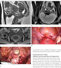 The added advantage of laparoscopy in endometriosis is that your diagnosis can be confirmed and if endometriosis can be seen during the laparoscopy, a sample will usually be taken for biopsy. Figure 3 From Findings Of Pelvic Endometriosis At Transvaginal Us Mr Imaging And Laparoscopy Semantic Scholar