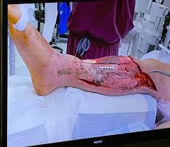 Awesemo On Twitter Project11 Warning Graphic Content Rooting For Alex S Smith Road To Recovery