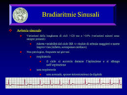 L'aritmia sinusale può verificarsi in persone di diverse fasce di età. Bradiaritmie Sinusali Bradicardia Sinusale Frequenza 60 Battiti Min Ipertono Vagale Durante Il Sonno La Frequenza Puo Scendere A 35 40 Bpm Con Ppt Download