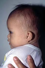 How Is Down Syndrome Diagnosed In The Newborn Hall S Ten Cardinal Signs Of Down Syndrome Neonatal Sign Poor Moro Reflex 85 Hypotonia 80 Flat Facial Profile 90 Upward Slanting Palpebral Fissures 80 Simple Small Round Ears 60 Redundant Loose