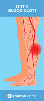 A clot blocks blood circulation through these veins, which carry blood from the lower body back to the heart. Blood Clot Cramp Or Pulled Muscle How Can I Tell The Difference