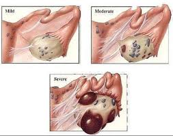 A person with stage 4 endometriosis has lots of endometrial tissue, which is growing inside several of the pelvic organs. Stages Endometriosis And Me