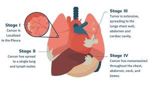 Medically, mesothelioma as a word itself means a tumor that is more likely to transform in a fast proliferating cancer which affects the mesothelial cells of an organ, which form the protective thin covering over the organs like heart, lungs and abdomen. Know About Mesothelioma Cance Delhi Cancer Hospital