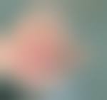 Image result for phlegmon of hand)