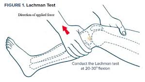 Image result for Lachman Test