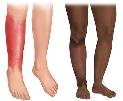 Image result for erysipel photos)