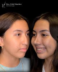 ✨ Recuerda que invertir en ti siempre será la mejor decisión ✨ La  rinoplastia no solo transforma tu perfil, también mejora tu respiración y  tu calidad de vida. 👩🏻‍⚕️ Dra. Ethel Sánchez -