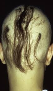 Key facts liquid amoxicillin can stain your teeth. Alopecia Areata An Overview Sciencedirect Topics