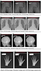 Pelvis x ray anatomy in this image you will find the sacroiliac joint acetabular obturator foramina greater trochanter pubic symphysis femoral. Examining Practitioners Assessments Of Perceived Aesthetic And Diagnostic Quality Of High Kvp Low Mas Pelvis Chest Skull And Hand Phantom Radiographs Journal Of Medical Imaging And Radiation Sciences