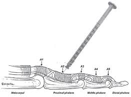 Image result for Tendon Sheath Injection
