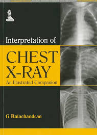 Image result for Chest XRay Interpretation