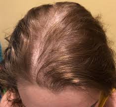 This is a super sensitive video for me, revealing my thin balding edges. Women S Hair Loss Treatment Solutions In Nj Mancuso Salon Spa