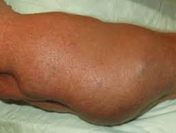 Dercum Disease Dermnet Nz