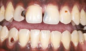 Treatment of cavities in front teeth fluoride: Humble Texas Dentist Smile Gallery Tooth Colored Filings