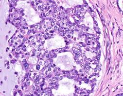 Malignant tumor ae med. das malignom pl.: Malignant Mixed Tumor Of Skin Springerlink