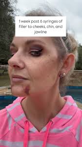 1 week out and swelling is gone but welcomed back 😂 , Bruising is healing  fast!, No tenderness or soreness at all, Loving having my chin back!, Thank  you Lindsay for giving me my girl back! 😂 💃🏼😘🩷