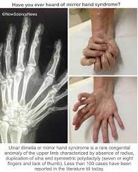 Mirror syndrome or triple oedema or ballantyne syndrome is a rare disorder affecting pregnant women. What Is Mirror Hand Syndrome Mirror Now Science News Facebook