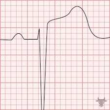 Image result for Left Ventricular Hypertrophy