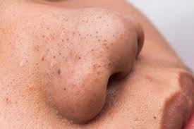 Basuh udang hingga bersih, kemudian gaulkan udang dengan… Cara Buang Blackhead Dan Whitehead Di Muka Secara Kekal Umie Oh Umie