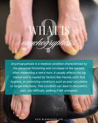 Image result for Onychogryphosis feet