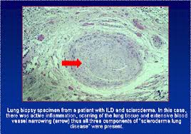 Lung Involvement In Scleroderma Michigan Medicine