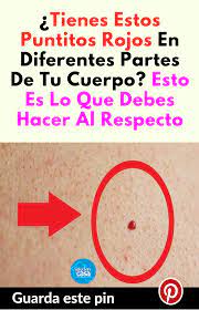 Tienes Estos Puntitos Rojos En Diferentes Partes De Tu Cuerpo Esto Es Lo Que Debes Hacer Al Respecto Atkins Diet Tips Skin