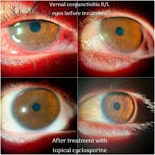 Image result for Vernal Conjunctivitis