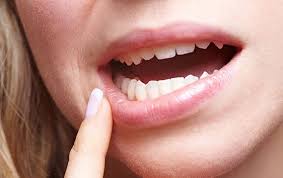 Lip Cancer
