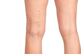 Sclerotherapy in East Grand Forks, MN | Sublime Aesthetic Professionals
