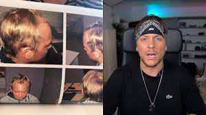 Er ist voller energie und nimmt kein blatt vor den mund. Ich Hatte Vier Haartransplantationen Uber Dieses Thema Konnte Ich Jahrelang Nicht Reden Youtube