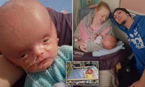 Baby Born With A Swollen Head Defies Doctors Who Told His Mother To Terminate Pregnancy Daily Mail Online